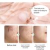 Acne Traces Cream Acne Scars Repair Cream Adolescent Acne Cream - Image 3